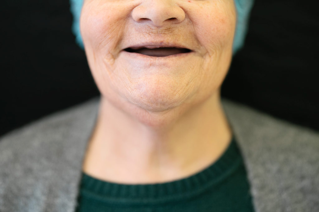 prótese dentária removível